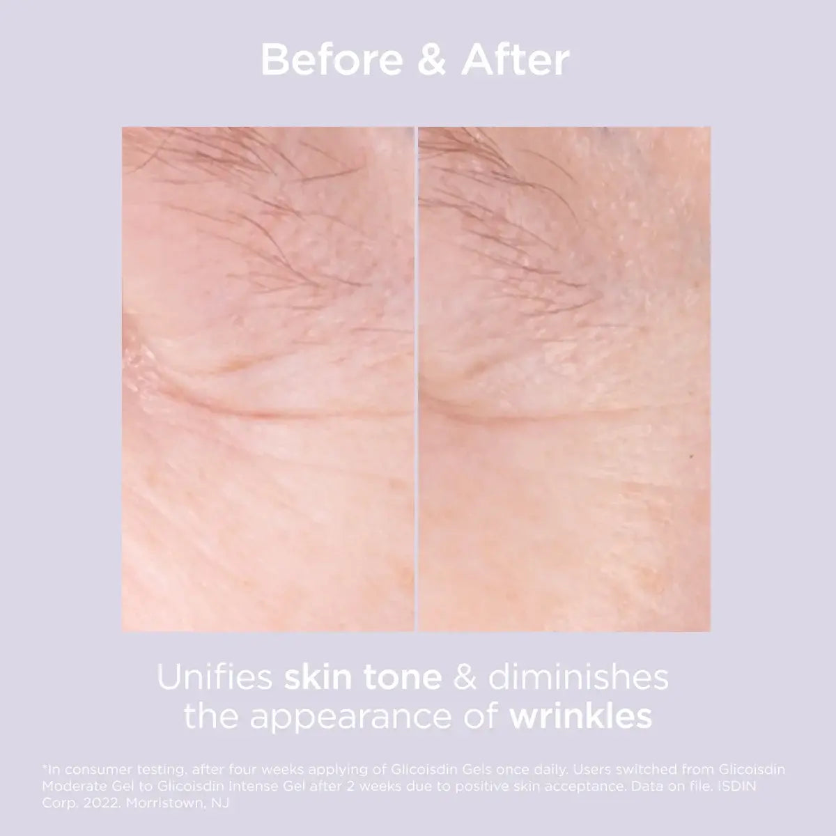 GLICOISDIN GEL- MODERATE 15%